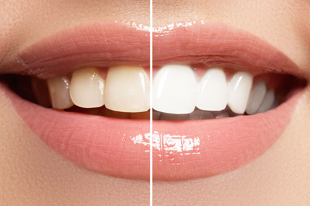 4 Common Teeth Whitening Procedures
