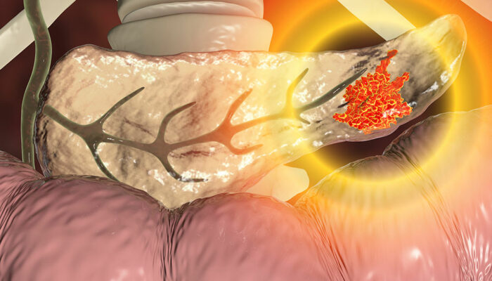 4 Simple Tips to Lower Pancreatic Cancer Risk