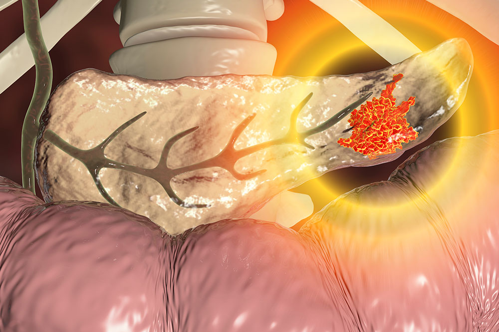 4 Simple Tips to Lower Pancreatic Cancer Risk