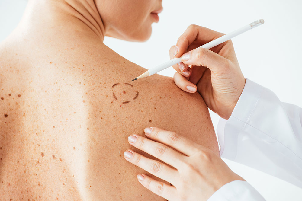 Melanoma – Diagnosis and Treatment