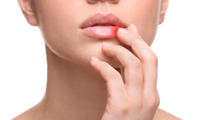 How to Treat Cold Sores at Home?